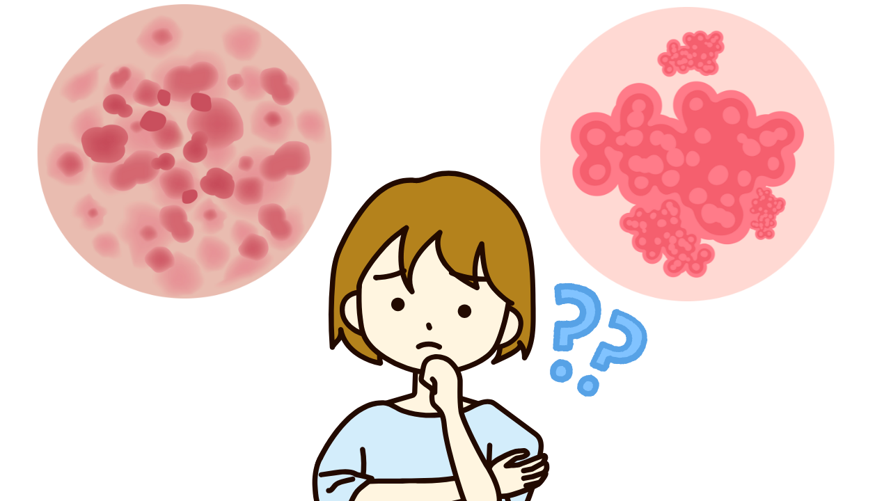 よだれかぶれと食物アレルギーの見分け方