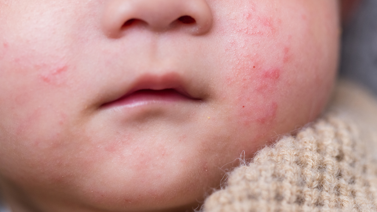 赤ちゃんのほっぺが赤くなる主な原因と対処法